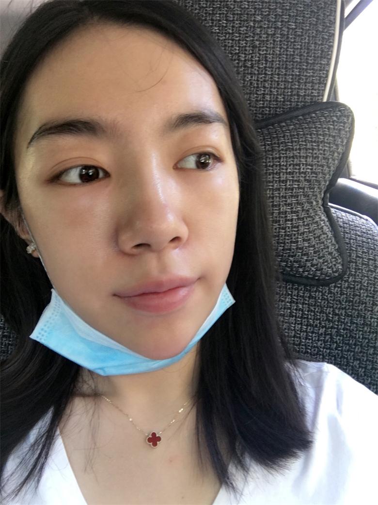 合肥壹加壹整形美容醫(yī)院做祛眼袋效果怎么樣？金大生祛眼袋案例分享