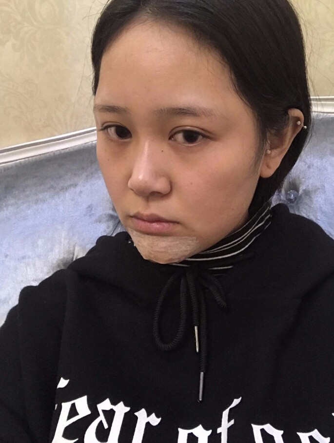 青島集美整形醫(yī)院做硅膠墊下巴怎么樣？趙煜楠醫(yī)生硅膠墊下巴真人案例