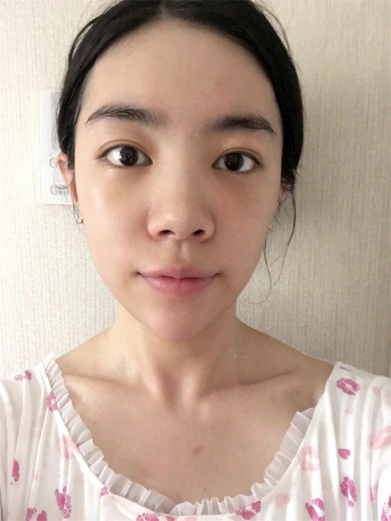 合肥壹加壹整形美容醫(yī)院做祛眼袋效果怎么樣？金大生祛眼袋案例分享
