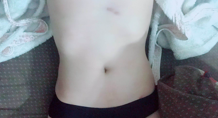 深圳晨曦整形醫(yī)院吉米斯做腰腹吸脂怎么樣？附吉米斯醫(yī)生腰腹吸脂案例