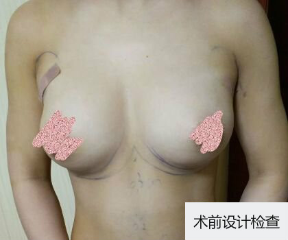 深圳博美整形醫(yī)生劉超做自體脂肪隆胸怎么樣？自體脂肪隆胸案例