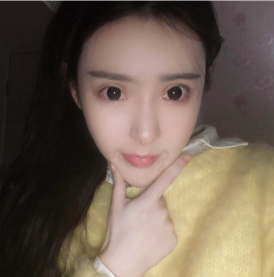 重慶柏漫醫(yī)療美容診所高紅艷醫(yī)生做面部吸脂怎么樣？面部吸脂案例分享