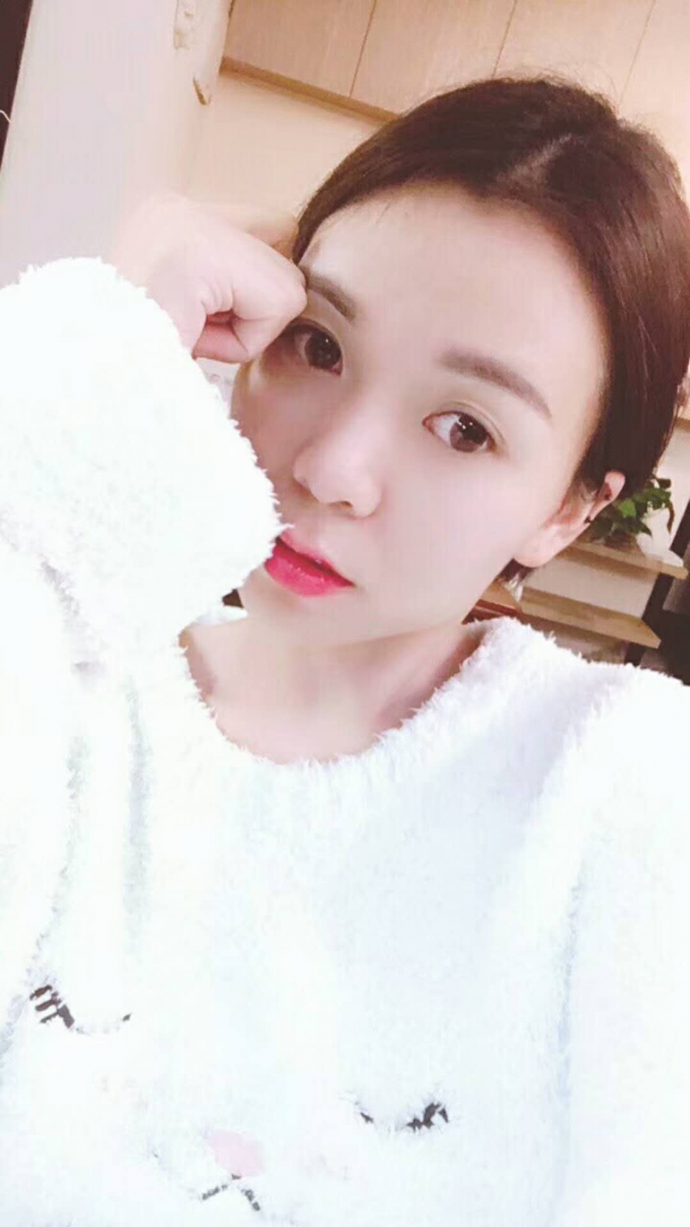 長沙星雅醫(yī)療美容醫(yī)院做埋線提升去法令紋效果怎么樣？附金振玉醫(yī)生案例