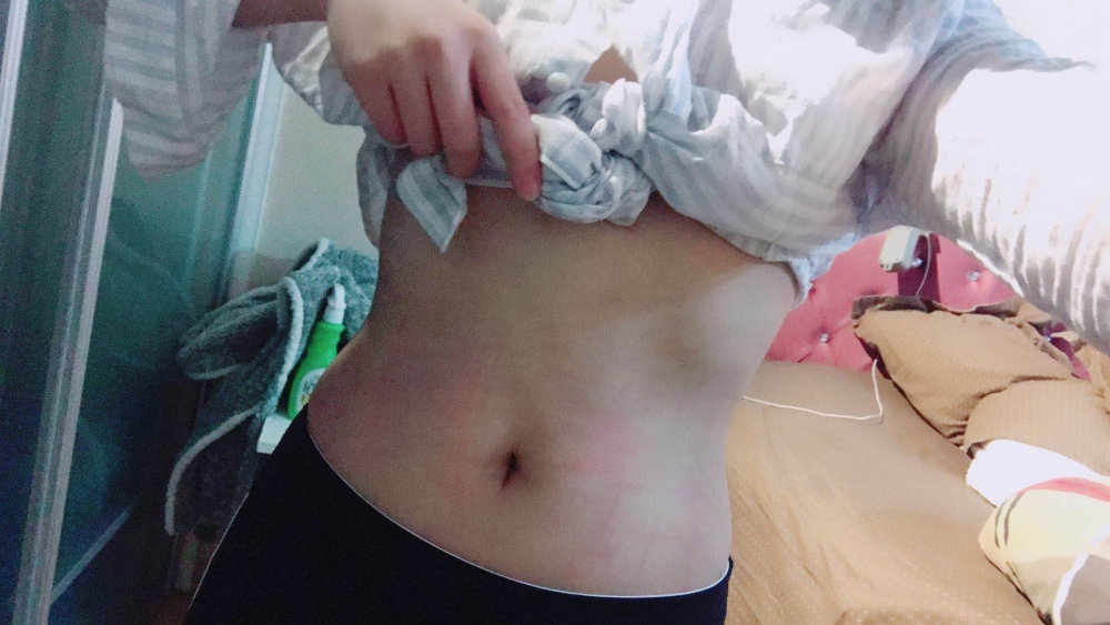 深圳晨曦整形醫(yī)院吉米斯做腰腹吸脂怎么樣？附吉米斯醫(yī)生腰腹吸脂案例