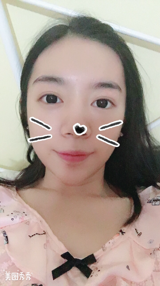 合肥壹加壹整形美容醫(yī)院做祛眼袋效果怎么樣？金大生祛眼袋案例分享