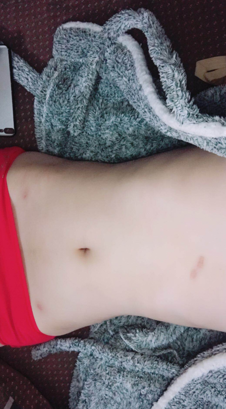 深圳晨曦整形醫(yī)院吉米斯做腰腹吸脂怎么樣？附吉米斯醫(yī)生腰腹吸脂案例
