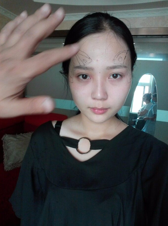 西安華仁醫(yī)院整形美容中心做自體脂肪填充效果怎么樣？附耿延鵬整形案例