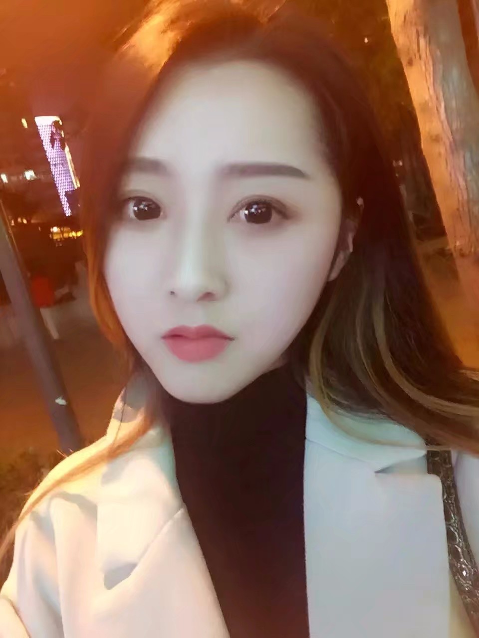 西安米蘭柏羽整形醫(yī)院李旭平做切開雙眼皮效果怎么樣？附案例