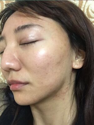 重慶柏漫醫(yī)療美容診所做激光祛痘效果怎么樣？白亞亞激光祛痘案例
