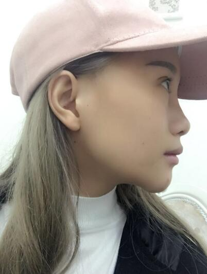 長春奧拉克美容醫(yī)院金相勛醫(yī)生做玻尿酸豐臥蠶怎么樣？附案例