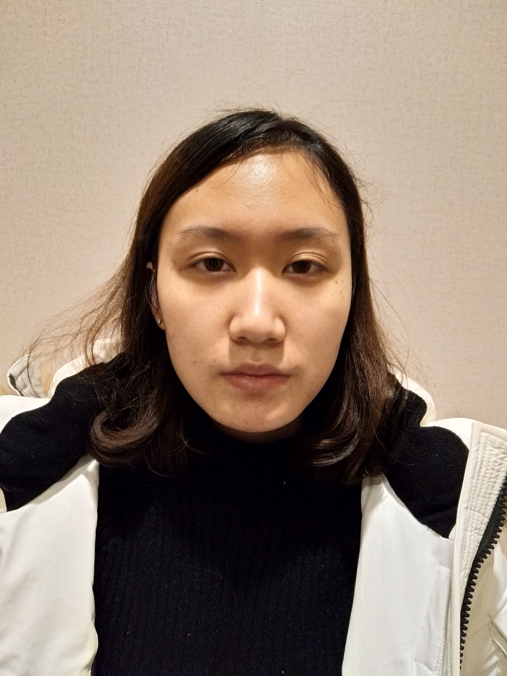 煙臺洛神醫(yī)學美容醫(yī)院張瑞允醫(yī)生做硅膠隆鼻怎么樣？附硅膠隆鼻案例