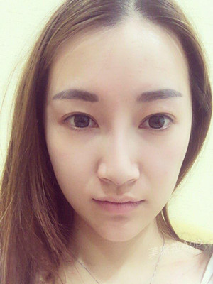 重慶五洲女子醫(yī)院整形美容中心做光子嫩膚怎么樣？淡明斌醫(yī)生光子嫩膚案例