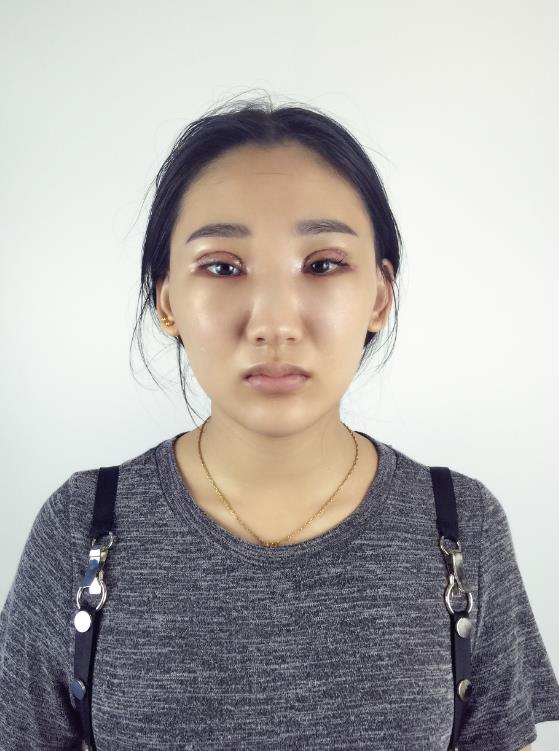 武漢中翰整形外科醫(yī)院沈磊醫(yī)生做切開(kāi)雙眼皮怎么樣？附沈磊切開(kāi)雙眼皮案例