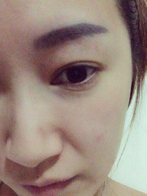重慶五洲女子醫(yī)院整形美容中心做光子嫩膚怎么樣？淡明斌醫(yī)生光子嫩膚案例