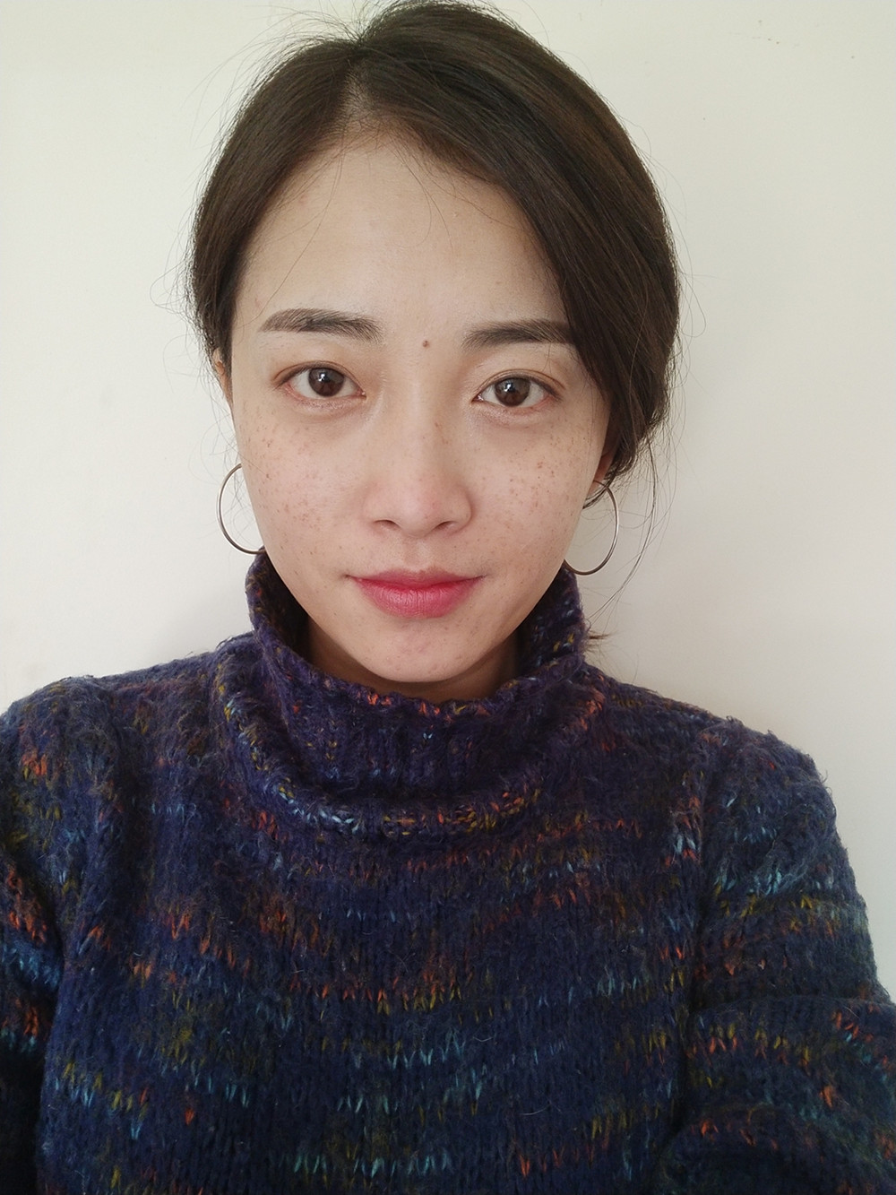 重慶當(dāng)代整形李敏旭醫(yī)生做皮秒激光祛斑效果怎么樣？附皮秒激光祛斑案例