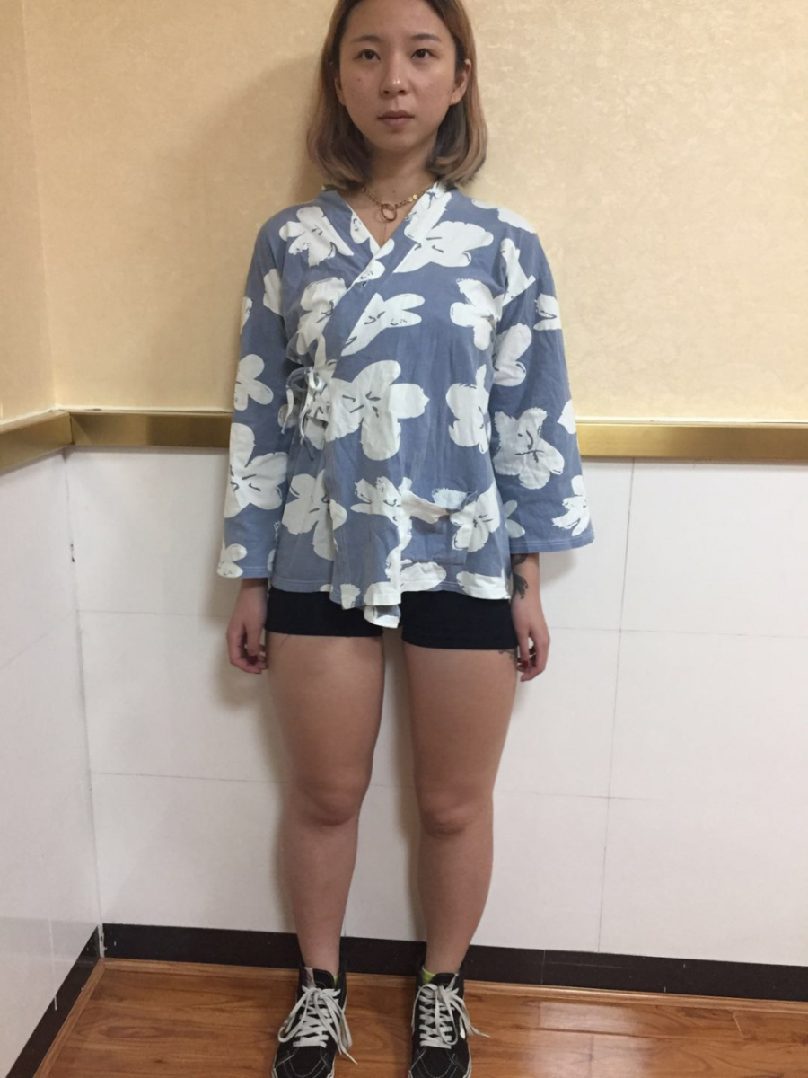深圳鵬愛(ài)醫(yī)療整形醫(yī)生張建文做大腿吸脂怎么樣？附大腿吸脂案例效果對(duì)比圖