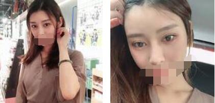 太原歐美蓮整形醫(yī)院丁曉峰醫(yī)生做雙眼皮怎么樣？丁曉峰雙眼皮手術案例分享