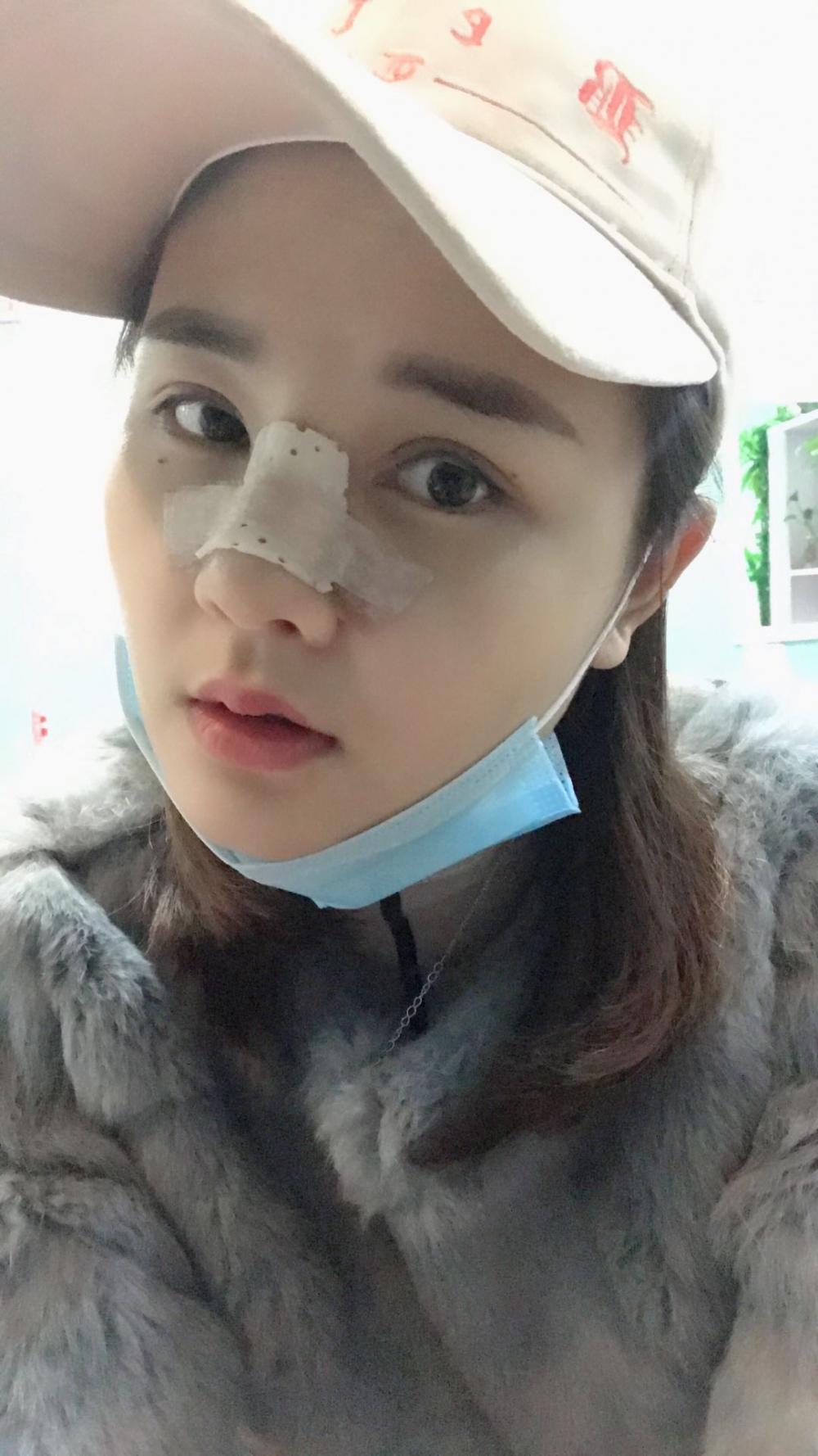 鄭州華領(lǐng)醫(yī)療美容醫(yī)院賀小虎醫(yī)生做眼綜合+鼻部整形手術(shù)效果怎么樣？
