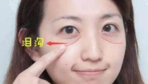 貴陽(yáng)顏之美整形自體脂肪填充淚溝