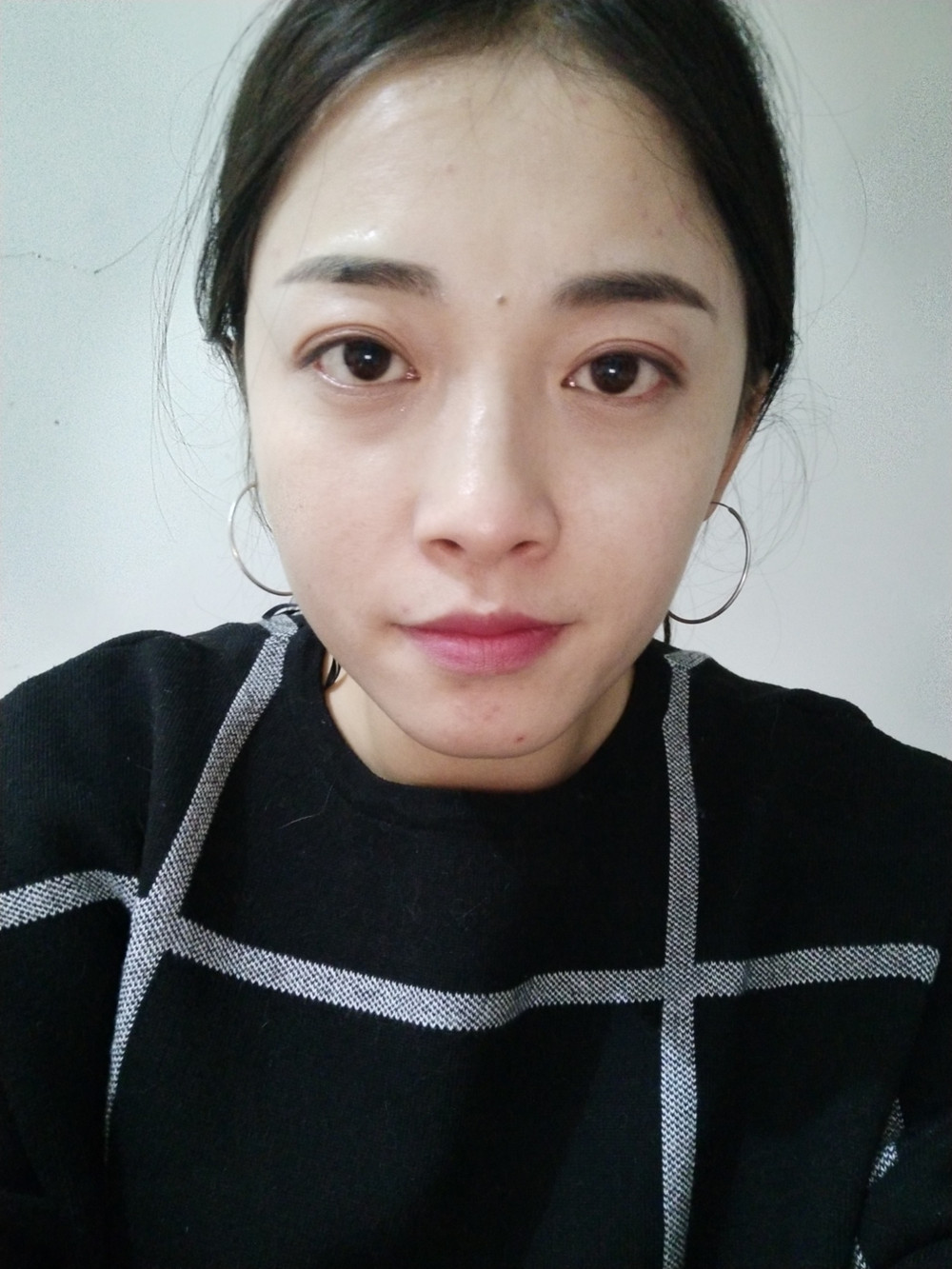 重慶當(dāng)代整形李敏旭醫(yī)生做皮秒激光祛斑效果怎么樣？附皮秒激光祛斑案例