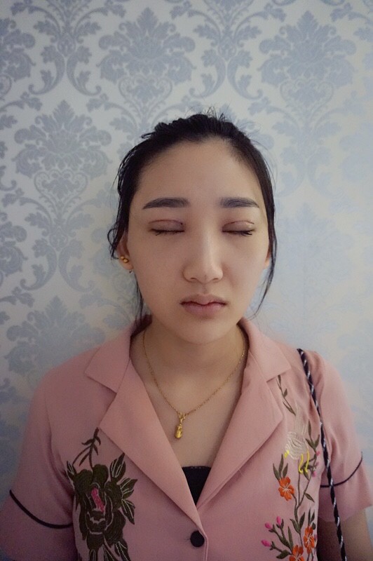 武漢中翰整形外科醫(yī)院沈磊醫(yī)生做切開(kāi)雙眼皮怎么樣？附沈磊切開(kāi)雙眼皮案例