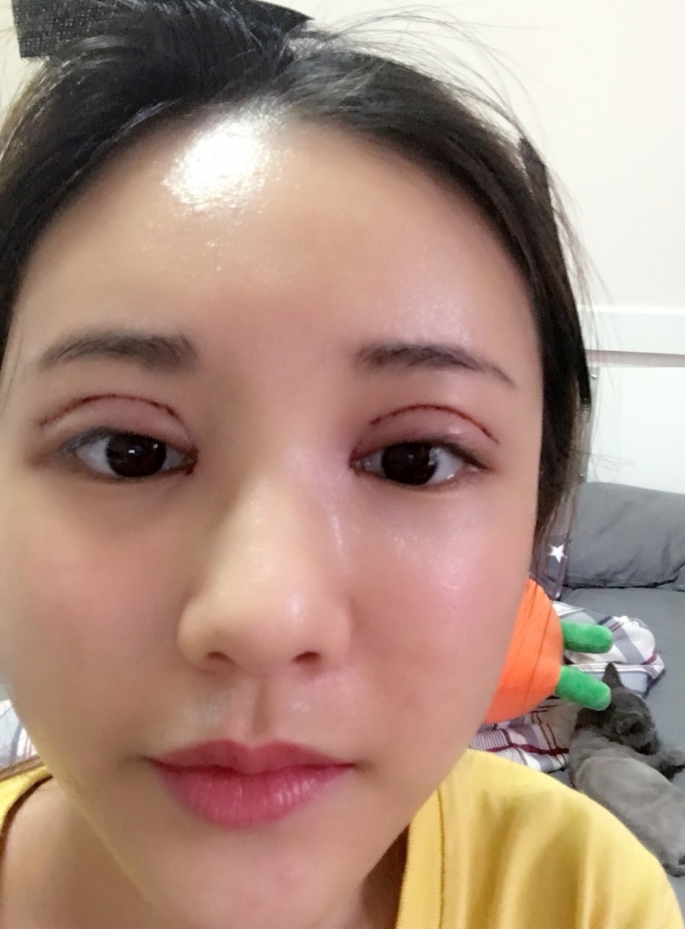 鄭州銘藝整形醫(yī)生陳濤做切開(kāi)雙眼皮怎么樣？鄭州銘藝切開(kāi)雙眼皮案例