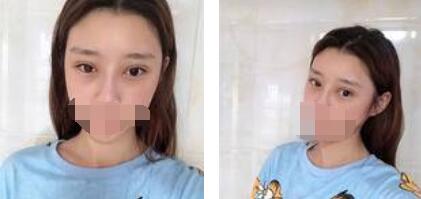 太原歐美蓮整形醫(yī)院丁曉峰醫(yī)生做雙眼皮怎么樣？丁曉峰雙眼皮手術案例分享
