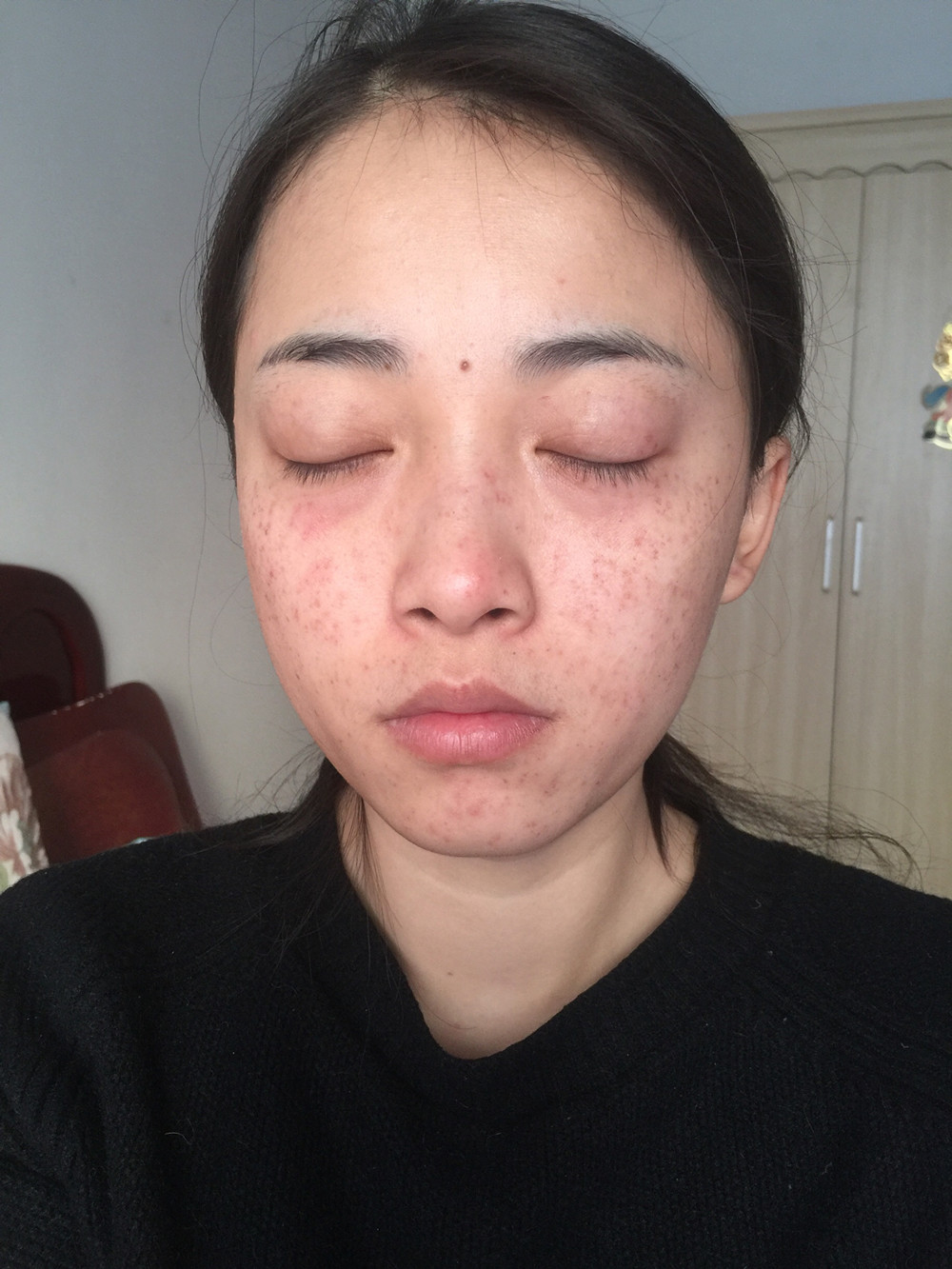 重慶當(dāng)代整形李敏旭醫(yī)生做皮秒激光祛斑效果怎么樣？附皮秒激光祛斑案例
