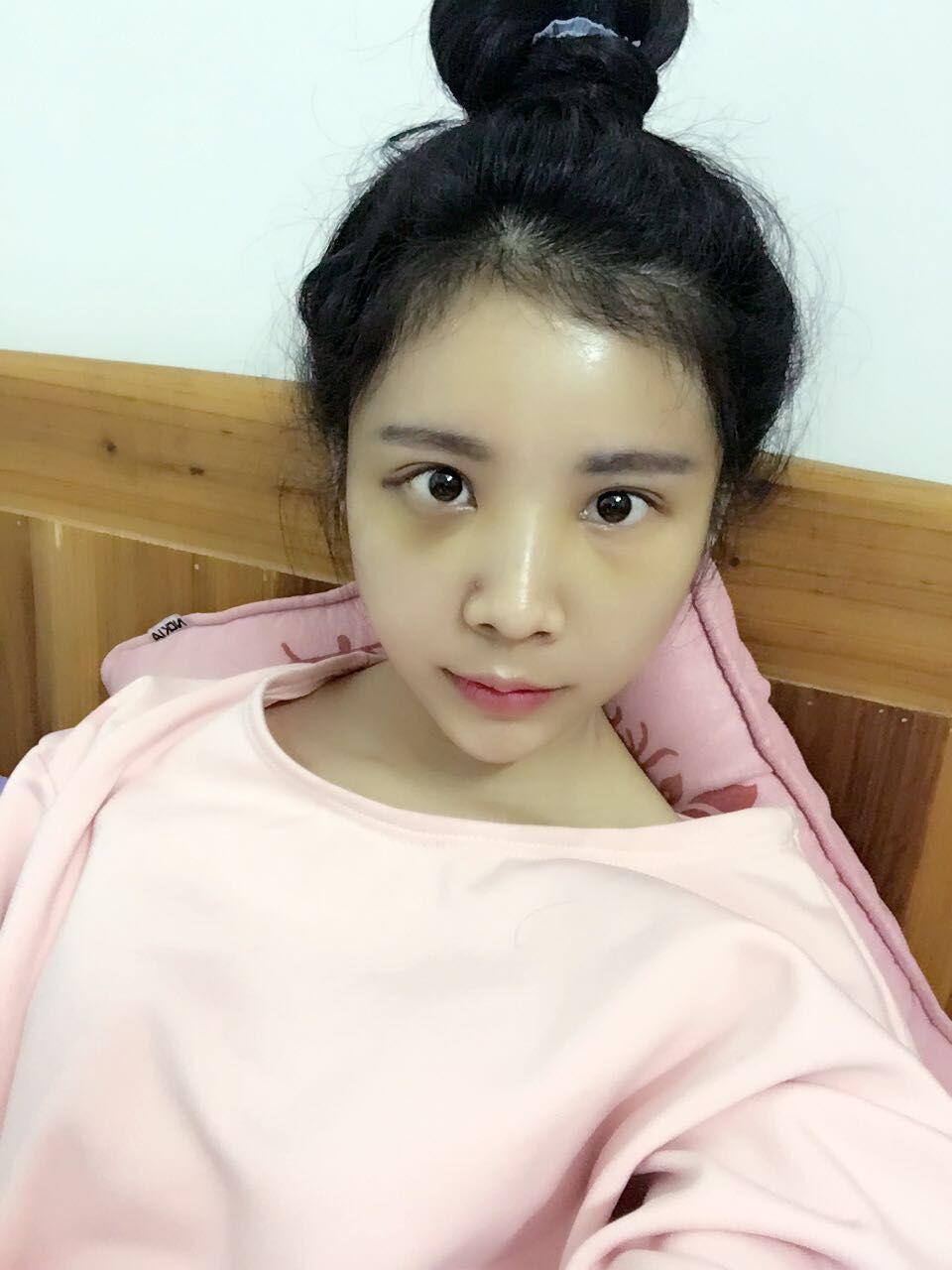 西安高一生醫(yī)療美容醫(yī)院網購恒醫(yī)生做自體脂肪全臉填充案例效果對比圖