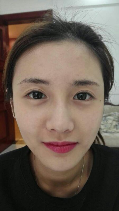 鄭州銘藝整形醫(yī)生陳濤做切開雙眼皮怎么樣？鄭州銘藝切開雙眼皮案例