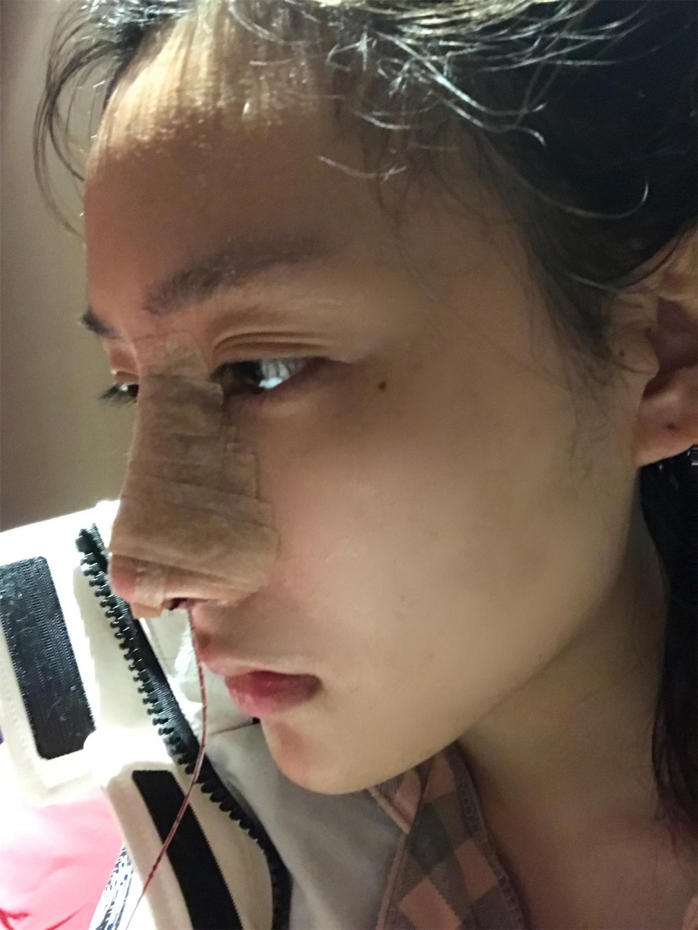 煙臺洛神醫(yī)學美容醫(yī)院張瑞允醫(yī)生做硅膠隆鼻怎么樣？附硅膠隆鼻案例