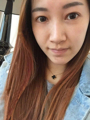重慶五洲女子醫(yī)院整形美容中心做光子嫩膚怎么樣？淡明斌醫(yī)生光子嫩膚案例