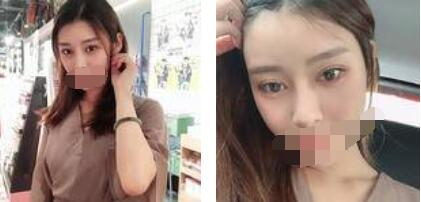 太原歐美蓮整形醫(yī)院丁曉峰醫(yī)生做雙眼皮怎么樣？丁曉峰雙眼皮手術案例分享
