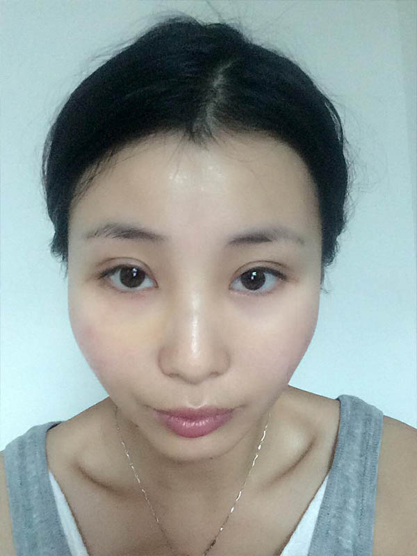 桂林新華醫(yī)療美容醫(yī)生李新華做雙眼皮手術(shù)怎么樣？李新華雙眼皮手術(shù)案例