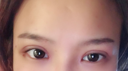長(zhǎng)春麥西美嘉整形醫(yī)生王圣博做雙眼皮手術(shù)效果怎么樣？附雙眼皮案例