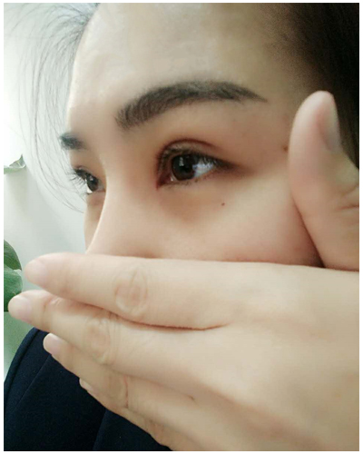 營口臻美醫(yī)療整形醫(yī)生閆迎軍做雙眼皮效果怎么樣？附雙眼皮案例對比圖