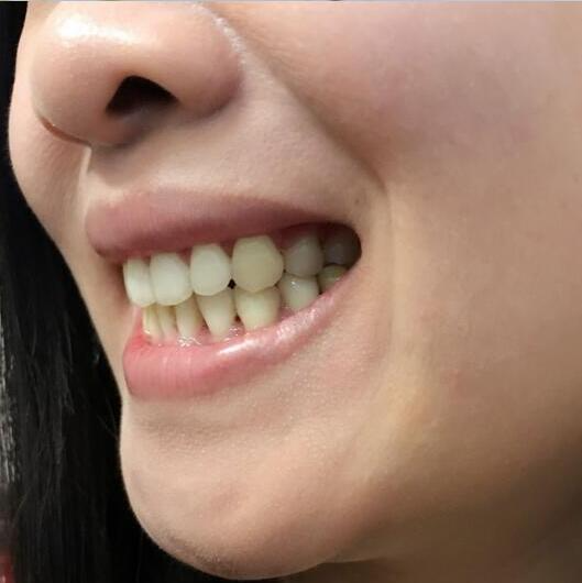 重慶嘉悅口腔醫(yī)院周繼祥醫(yī)生做金屬托槽矯正效果怎么樣？附案例效果對(duì)比圖