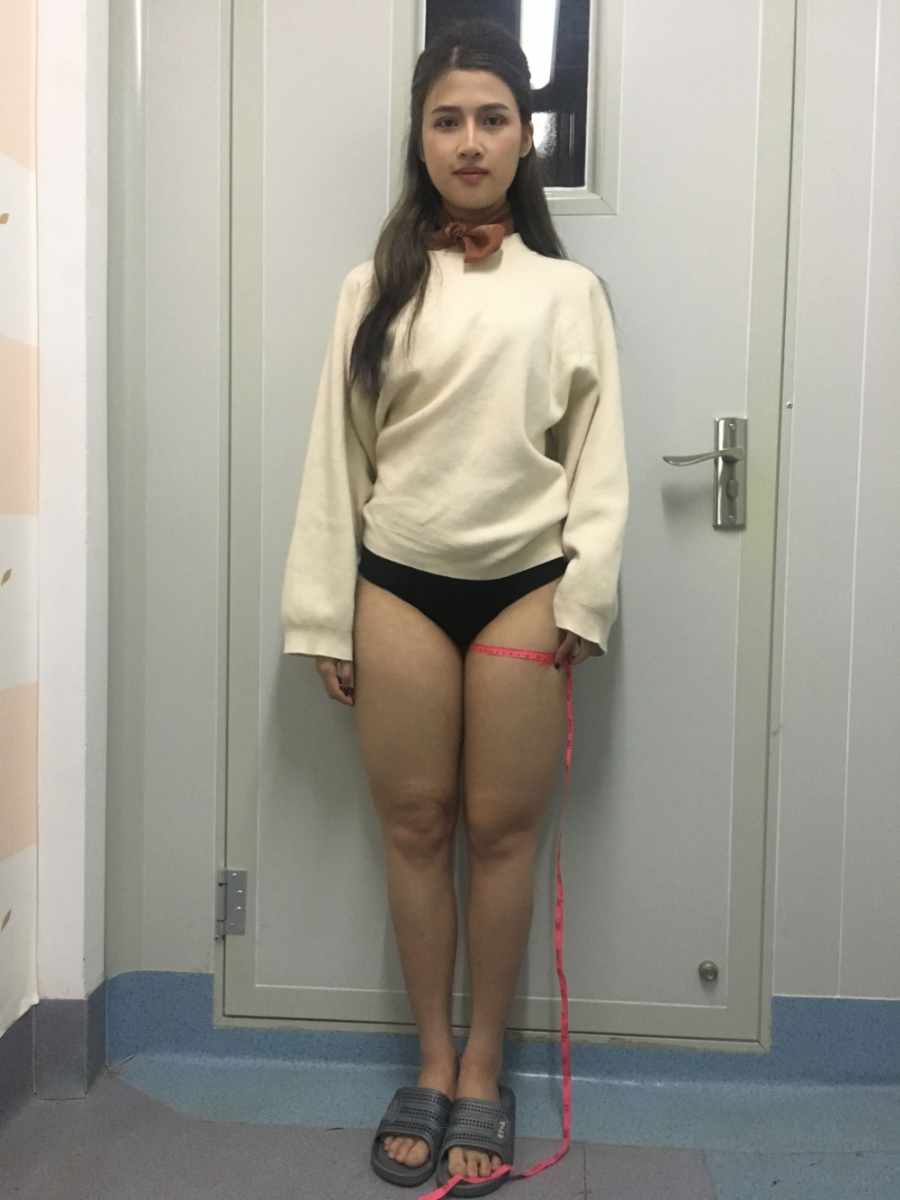 晉城鳳凰整形美容醫(yī)院宋發(fā)興醫(yī)生做大腿吸脂怎么樣？附大腿吸脂案例
