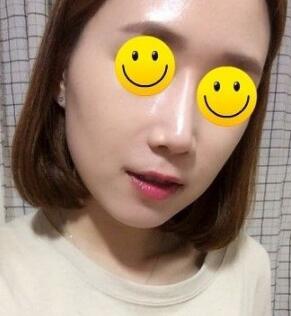 信陽東方藝美容醫(yī)院劉力萌做玻尿酸去法令紋效果怎么樣？附案例效果對比圖