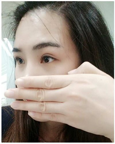 營口臻美醫(yī)療整形醫(yī)生閆迎軍做雙眼皮效果怎么樣？附雙眼皮案例對比圖