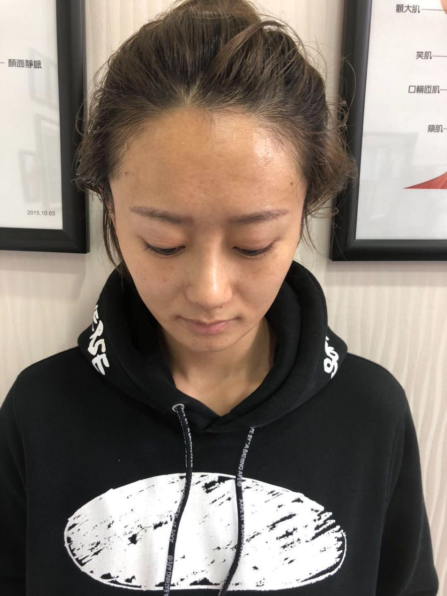 杭州迪美整形常德成醫(yī)生做鼻綜合整形技術(shù)怎么樣？附鼻綜合整形案例