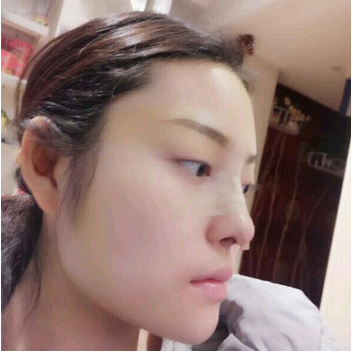 武漢維納斯整形醫(yī)院韓國濤醫(yī)生做鼻綜合整形怎么樣？附鼻綜合整形案例