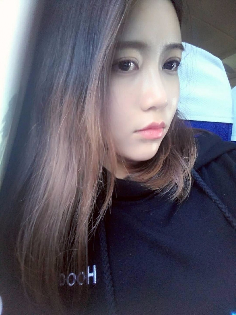 重慶美圣美邦整形醫(yī)院劉力維醫(yī)生做自體脂肪全臉填充案例效果對比圖