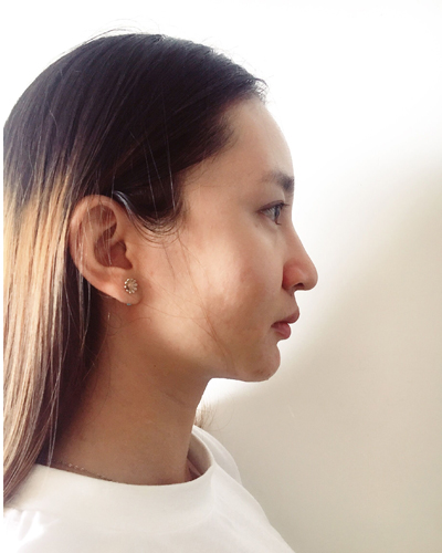 武漢維納斯整形醫(yī)院趙瑾醫(yī)生做玻尿酸墊下巴怎么樣？附玻尿酸墊下巴案例