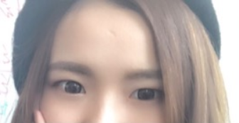 長(zhǎng)春麥西美嘉整形醫(yī)生王圣博做雙眼皮手術(shù)效果怎么樣？附雙眼皮案例