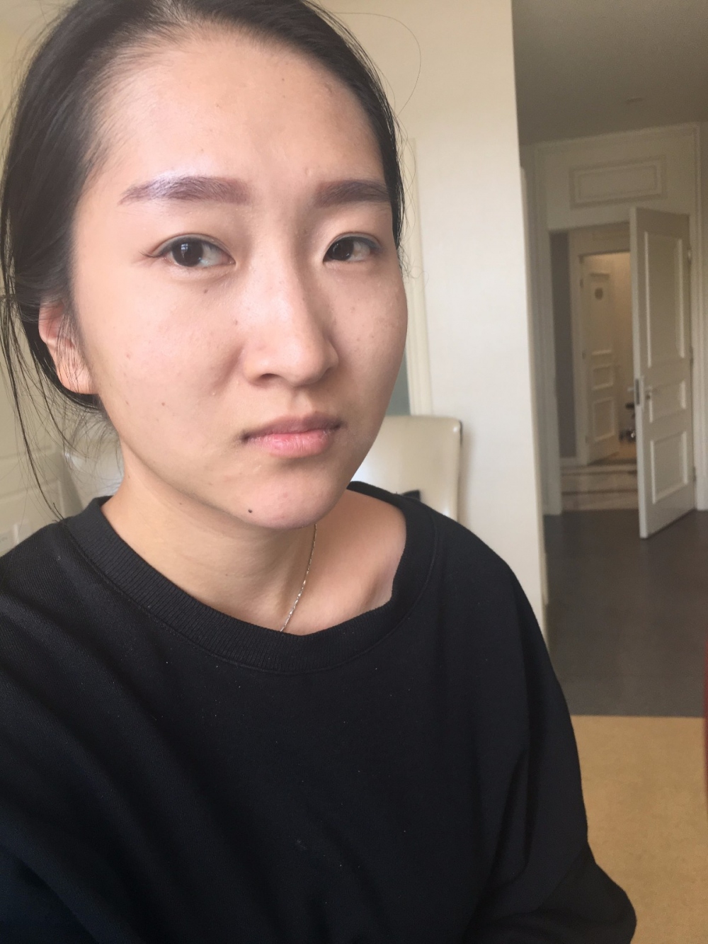 廣州廣大整形美容醫(yī)院任生醫(yī)生做玻尿酸豐面頰+注射瘦臉案例效果對比圖