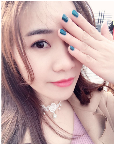 營口臻美醫(yī)療整形醫(yī)生閆迎軍做雙眼皮效果怎么樣？附雙眼皮案例對比圖