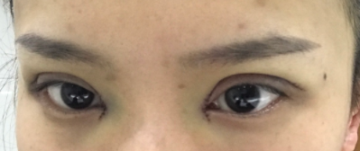 長(zhǎng)春麥西美嘉整形醫(yī)生王圣博做雙眼皮手術(shù)效果怎么樣？附雙眼皮案例