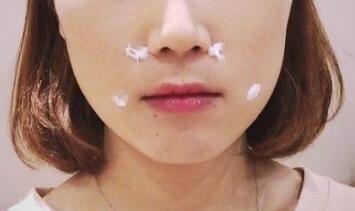 信陽東方藝美容醫(yī)院劉力萌做玻尿酸去法令紋效果怎么樣？附案例效果對比圖