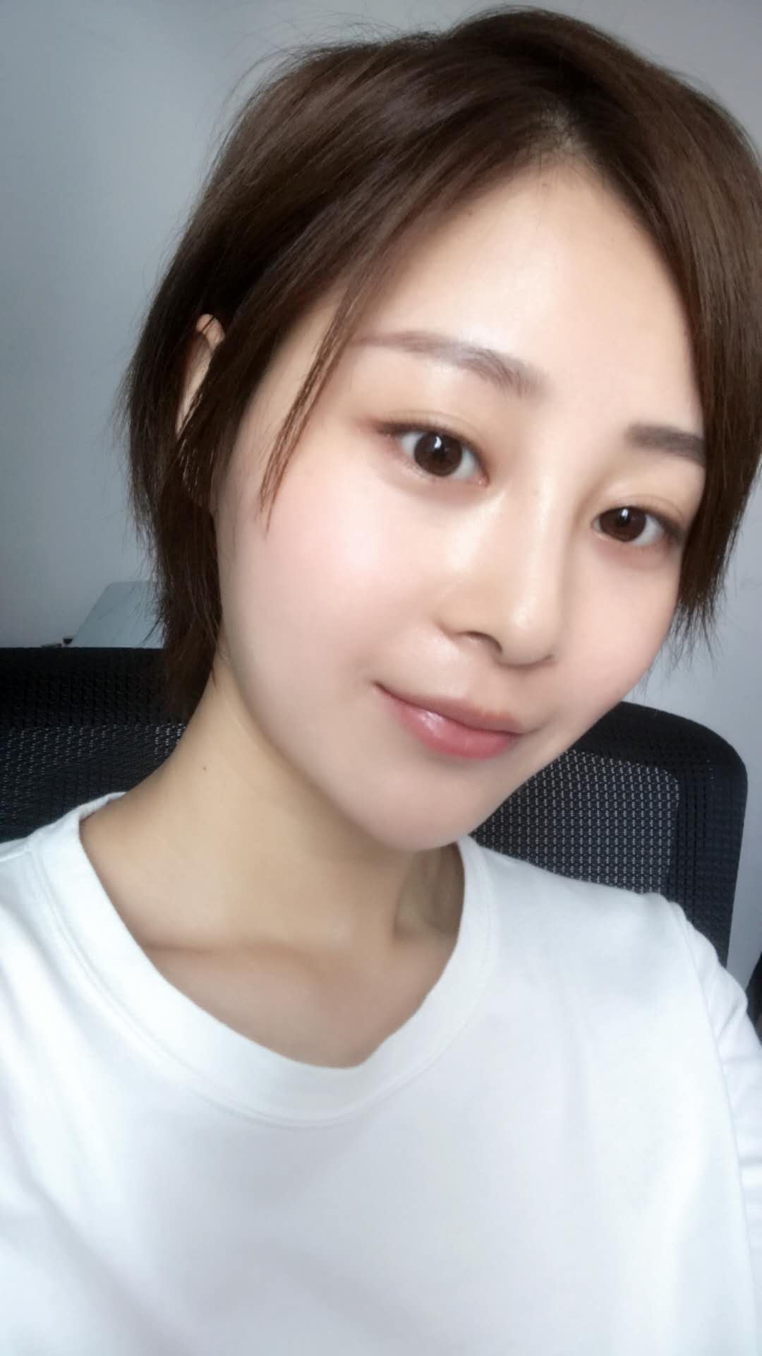 天津歐華威莎整形醫(yī)生姚玲做面部埋線提升效果怎么樣？附埋線提升案例